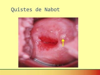 Quistes de Nabot 
