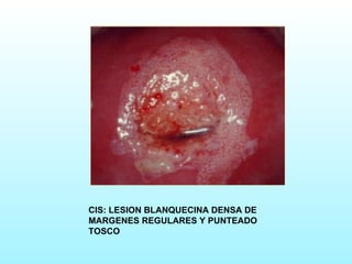 CIS: LESION BLANQUECINA DENSA DE MARGENES REGULARES Y PUNTEADO TOSCO 