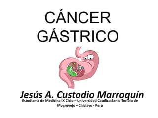 CÁNCER
        GÁSTRICO


Jesús A. Custodio Marroquín
Estudiante de Medicina IX Ciclo – Universidad Católica Santo Toribio de
                    Mogrovejo – Chiclayo - Perú
 