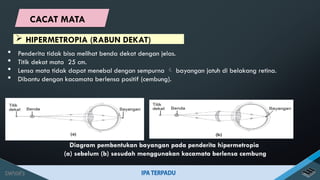  HIPERMETROPIA (RABUN DEKAT)
 Penderita tidak bisa melihat benda dekat dengan jelas.
 Titik dekat mata 25 cm.
 Lensa mata tidak dapat menebal dengan sempurna  bayangan jatuh di belakang retina.
 Dibantu dengan kacamata berlensa positif (cembung).
Diagram pembentukan bayangan pada penderita hipermetropia
(a) sebelum (b) sesudah menggunakan kacamata berlensa cembung
CACAT MATA
 
