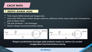  Tidak dapat melihat benda jauh dengan jelas.
 Lensa mata tidak dapat menipis dengan sempurna, akibatnya benda yang sangat jauh, bayangannya
jatuh di depan retina.
 Titik jauh penderita < tak berhingga.
 Dibantu dengan kacamata berlensa cekung.
Diagram pembentukan bayangan pada penderita miopia (a) sebelum (b) sesudah
menggunakan kacamata berlensa cekung
 MIOPIA (RABUN JAUH)
CACAT MATA
 