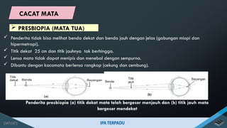  Penderita tidak bisa melihat benda dekat dan benda jauh dengan jelas (gabungan miopi dan
hipermetropi).
 Titik dekat 25 cm dan titik jauhnya tak berhingga.
 Lensa mata tidak dapat menipis dan menebal dengan sempurna.
 Dibantu dengan kacamata berlensa rangkap (cekung dan cembung).
Penderita presbiopia (a) titik dekat mata telah bergeser menjauh dan (b) titik jauh mata
bergeser mendekat
 PRESBIOPIA (MATA TUA)
CACAT MATA
 