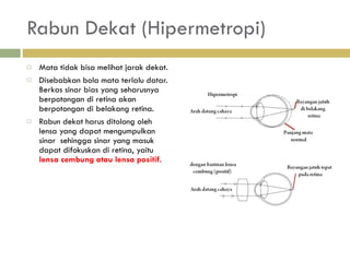Rabun Dekat (Hipermetropi) Mata tidak bisa melihat jarak dekat. Disebabkan bola mata terlalu datar. Berkas sinar bias yang seharusnya berpotongan di retina akan berpotongan di belakang retina.  Rabun dekat harus ditolong oleh lensa yang dapat mengumpulkan sinar  sehingga sinar yang masuk dapat difokuskan di retina, yaitu  lensa cembung atau lensa positif. 