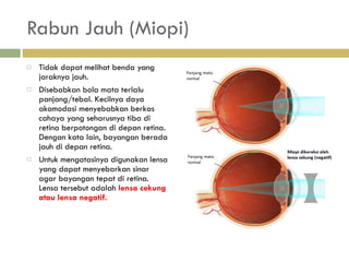 Rabun Jauh (Miopi) Tidak dapat melihat benda yang jaraknya jauh. D isebabkan bola mata terlalu  panjang/tebal. Kecilnya daya akomodasi menyebabkan berkas cahaya yang seharusnya tiba di retina berpotongan di depan retina. Dengan kata lain, bayangan berada jauh di depan retina. U ntuk mengatasinya digunakan  lensa yang dapat menyebarkan sinar agar  bayangan tepat di retina. Lensa tersebut adalah  lensa cekung atau lensa negatif. 