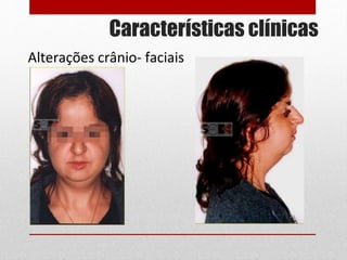Características clínicas
Alterações crânio- faciais
 