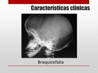 Braquicefalia
Características clínicas
 