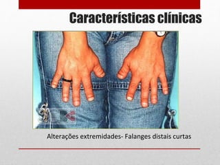 Alterações extremidades- Falanges distais curtas
Características clínicas
 