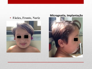 • Fácies, Fronte, Nariz
Micrognatia, Implantação
 