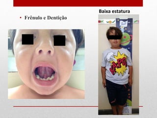 • Frênulo e Dentição
Baixa estatura
 