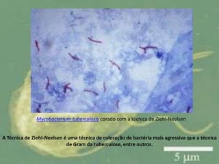 A Técnica de Ziehl-Neelsen é uma técnica de coloração de bactéria mais agressiva que a técnica
de Gram da tuberculose, entre outros.
Mycobacterium tuberculosis corado com a técnica de Ziehl-Neelsen
 