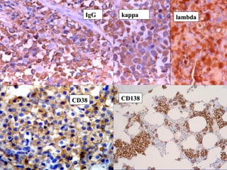 IgGIgG kappakappa
CD38CD38 CD138CD138
lambdalambda
 
