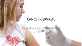 CANCER CERVICAL
Cajas Montenegro Carlos Michaell
 