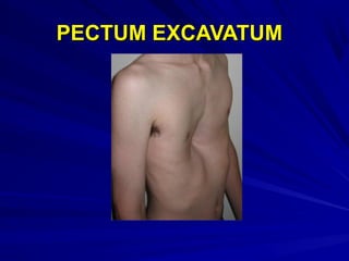 PECTUM EXCAVATUMPECTUM EXCAVATUM
 