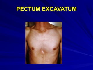 PECTUM EXCAVATUMPECTUM EXCAVATUM
 