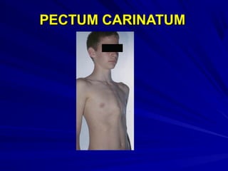 PECTUM CARINATUMPECTUM CARINATUM
 