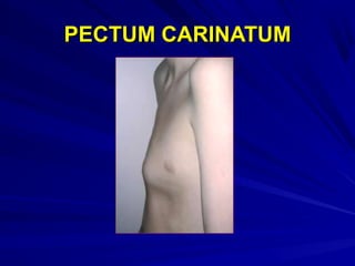 PECTUM CARINATUMPECTUM CARINATUM
 