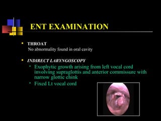 ENT EXAMINATION
 THROAT
No abnormality found in oral cavity
 INDIRECT LARYNGOSCOPY
 Exophytic growth arising from left vocal cord
involving supraglottis and anterior commissure with
narrow glottic chink
 Fixed Lt vocal cord
 