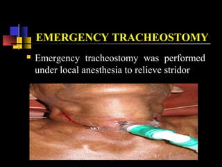 EMERGENCY TRACHEOSTOMY
 Emergency tracheostomy was performed
under local anesthesia to relieve stridor
 