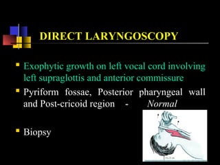 DIRECT LARYNGOSCOPY
 Exophytic growth on left vocal cord involving
left supraglottis and anterior commissure
 Pyriform fossae, Posterior pharyngeal wall
and Post-cricoid region - Normal
 Biopsy
 