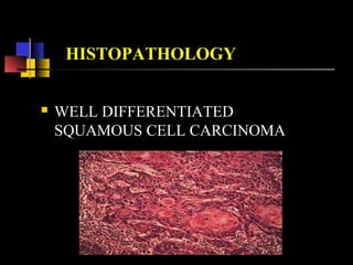 HISTOPATHOLOGY
 WELL DIFFERENTIATED
SQUAMOUS CELL CARCINOMA
 
