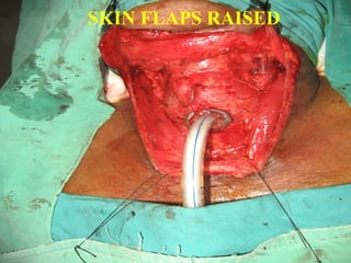 DISSECTION CONTINUES
 