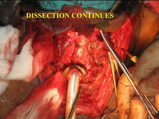 LARYNX DISSECTED FROM STERNOMASTOID
AND CAROTID SHEATH
 
