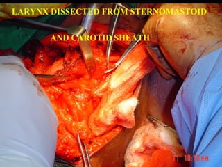 CONTRALATERAL THYRIOD FREED
& SECURED
 