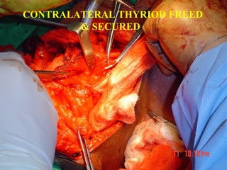 STRAP MUSCLES SECTIONED
& LARYNX MOBILIZED
 