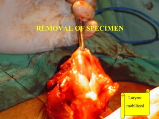 LARYNX REMOVED
 