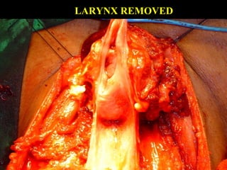 NASOGASTRIC TUBE PASSED
 