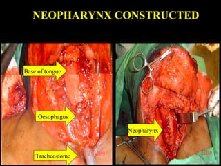 SUCTION DRAINS PLACED WITHOUT
CROSSING THE NEOPHARYNX
SUCTION DRAIN
SUCTION
DRAIN
NEOPHARYNX
 