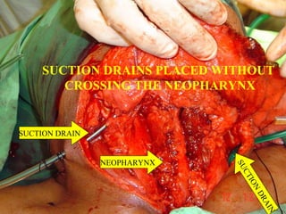 TRACHEOSTOME FASHIONED
& WOUND CLOSSED
TRACHEOSTOME
 