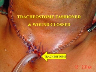 THE TRANSGLOTTIC GROWTH
The Resected Specimen
 