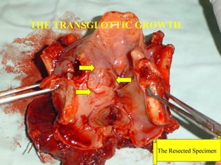POST OP MANAGEMENT
 Tracheostomy care
 Antibiotics :
 Inj ceftriaxone 1g I/V 12 hourly (ATD)
 Inj metronidazole 500mg I/V 8 hourly
 Inj coamoxiclav 1.2g I/V 8 hourly (ATD)
 Inj Diclofenac Sodium 75mg I/M 12 hourly
 Omeprazole infusion 40mg I/V HS
 Intra venous fluids
 