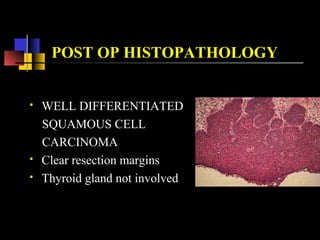  Regular follow-up
 Adjuvant Radiotherapy
 Voice Rehabilitation Healthy stoma
FOLLOW UP
Healthy stoma
 