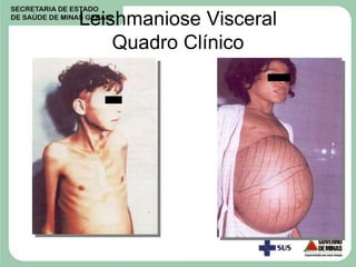 Leishmaniose Visceral
Quadro Clínico
 