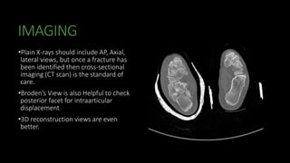 Calcaneal fracture | PPTX