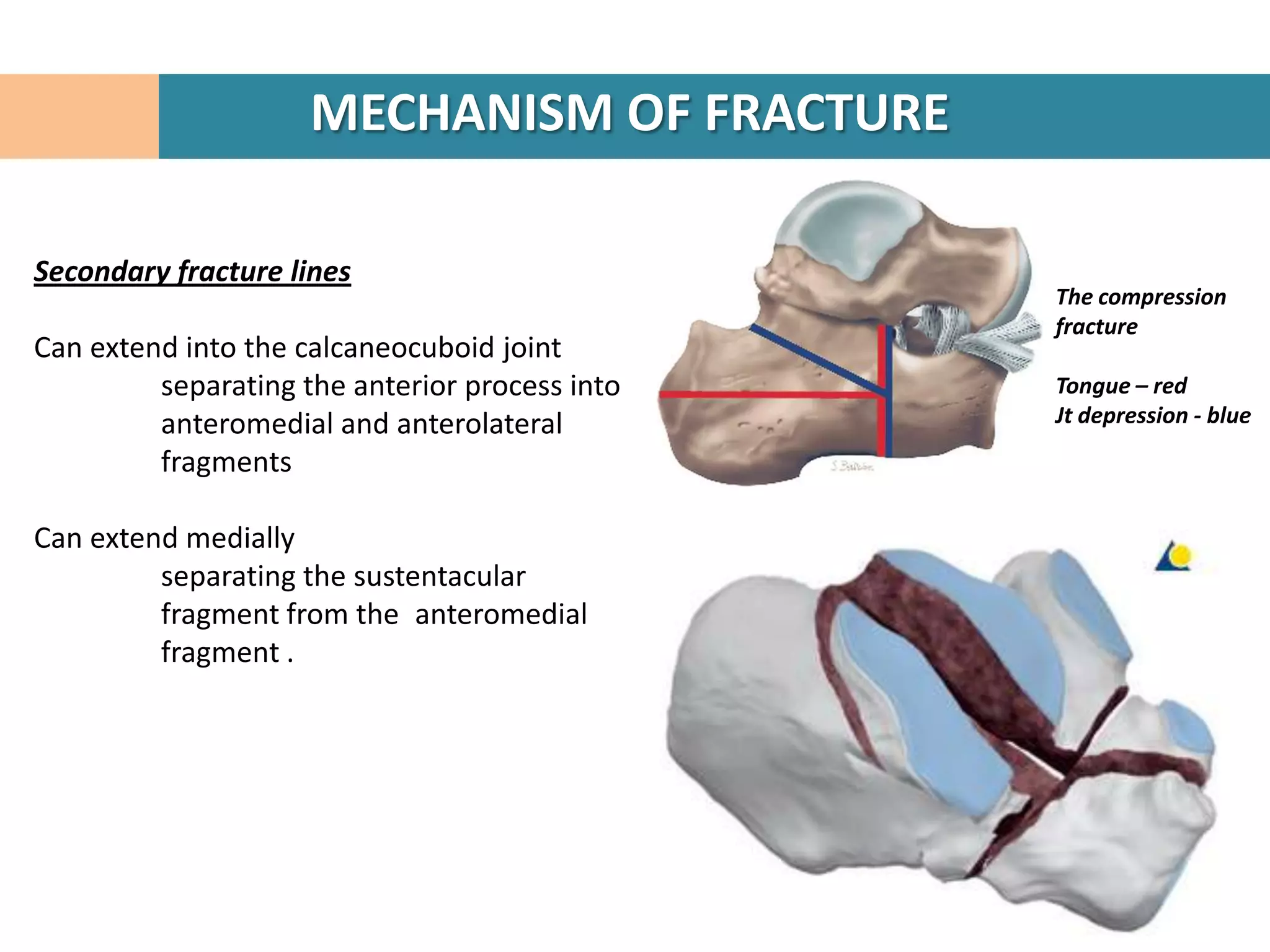 MECHANISM OF FRACTURE

Secondary fracture lines
                                                The compression
                                                fracture
Can extend into the calcaneocuboid joint
         separating the anterior process into   Tongue – red
         anteromedial and anterolateral         Jt depression - blue
         fragments

Can extend medially
         separating the sustentacular
         fragment from the anteromedial
         fragment .
 