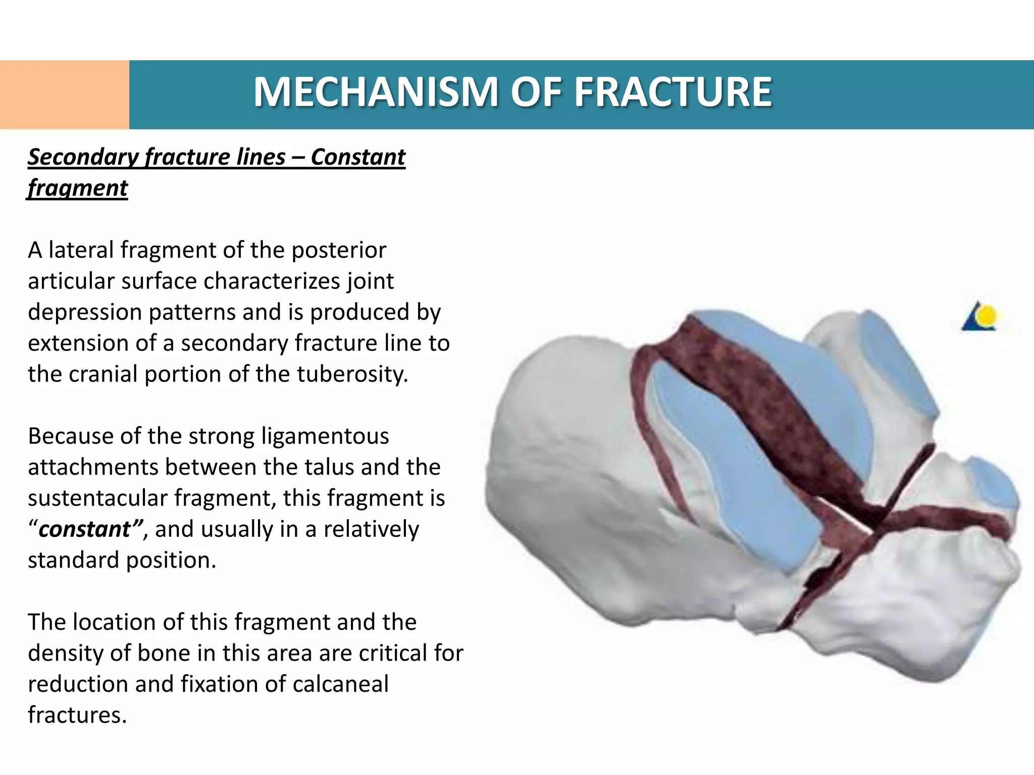 MECHANISM OF FRACTURE
Secondary fracture lines – Constant
fragment

A lateral fragment of the posterior
articular surface characterizes joint
depression patterns and is produced by
extension of a secondary fracture line to
the cranial portion of the tuberosity.

Because of the strong ligamentous
attachments between the talus and the
sustentacular fragment, this fragment is
“constant”, and usually in a relatively
standard position.

The location of this fragment and the
density of bone in this area are critical for
reduction and fixation of calcaneal
fractures.
 