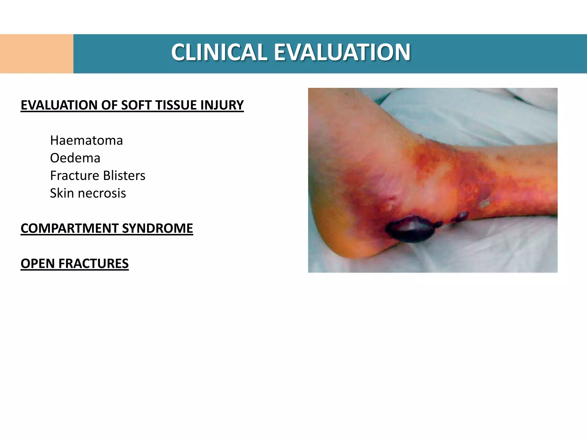 CLINICAL EVALUATION
EVALUATION OF SOFT TISSUE INJURY

    Haematoma
    Oedema
    Fracture Blisters
    Skin necrosis

COMPARTMENT SYNDROME

OPEN FRACTURES
 