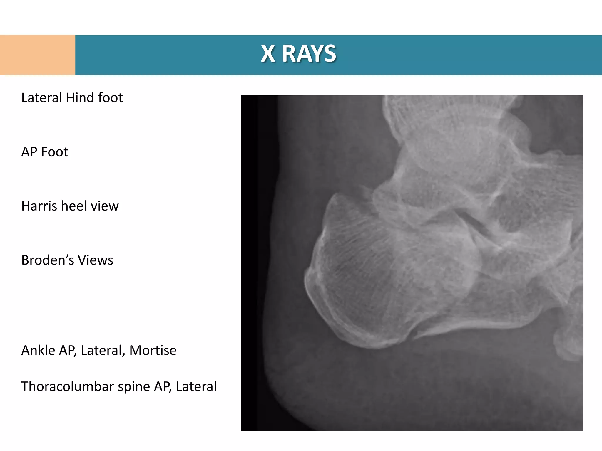 X RAYS
Lateral Hind foot


AP Foot


Harris heel view


Broden’s Views




Ankle AP, Lateral, Mortise

Thoracolumbar spine AP, Lateral
 