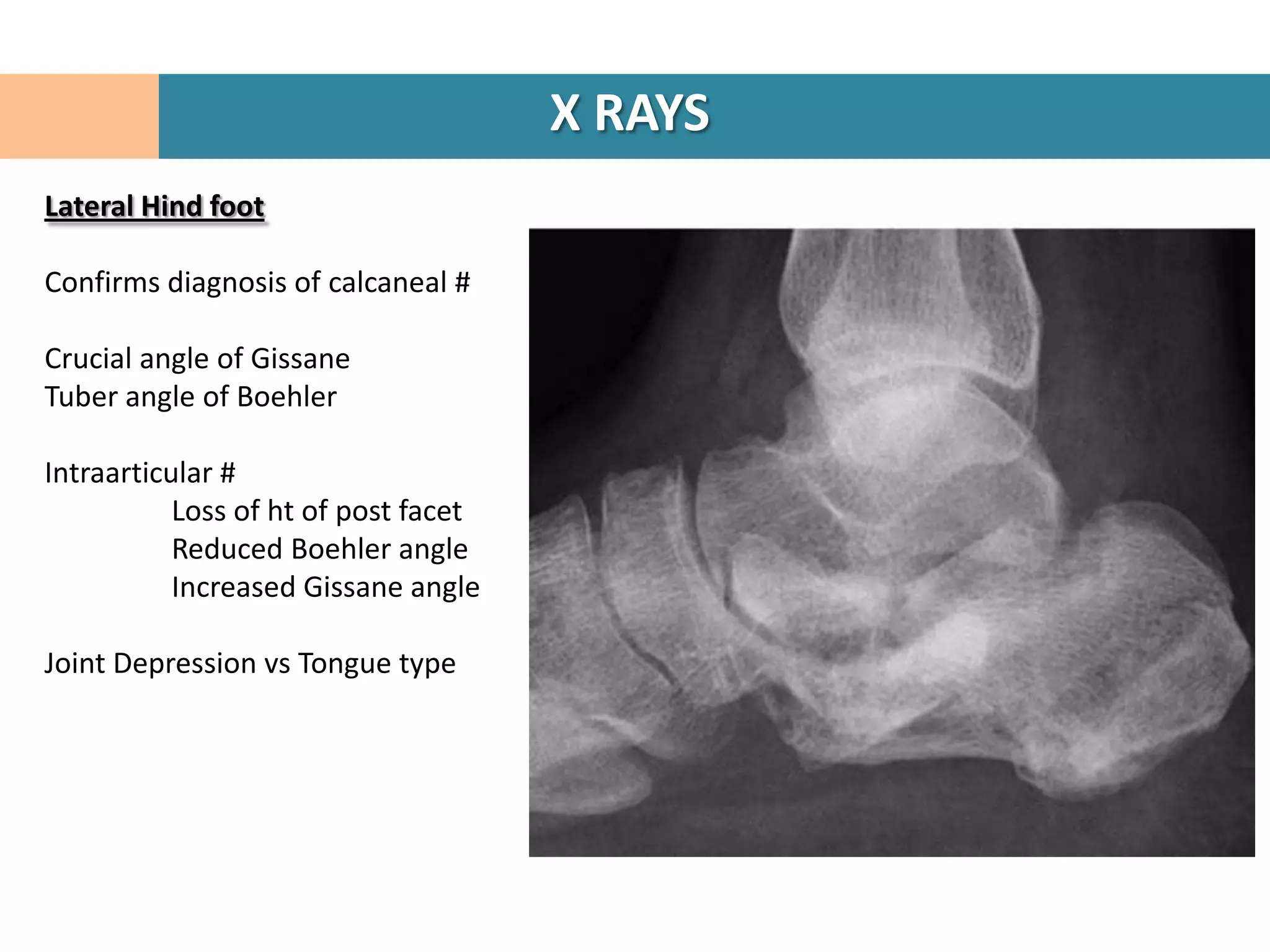 X RAYS
Lateral Hind foot

Confirms diagnosis of calcaneal #

Crucial angle of Gissane
Tuber angle of Boehler

Intraarticular #
           Loss of ht of post facet
           Reduced Boehler angle
           Increased Gissane angle

Joint Depression vs Tongue type
 