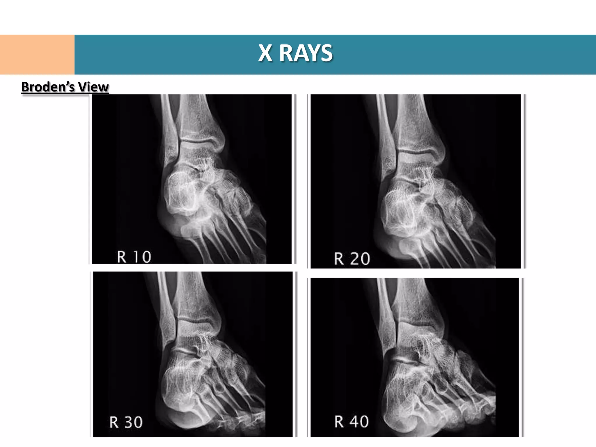 X RAYS
Broden’s View
 
