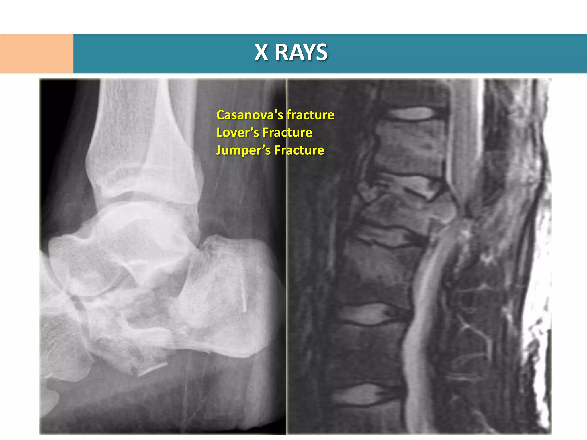 X RAYS

Casanova's fracture
Lover’s Fracture
Jumper’s Fracture
 