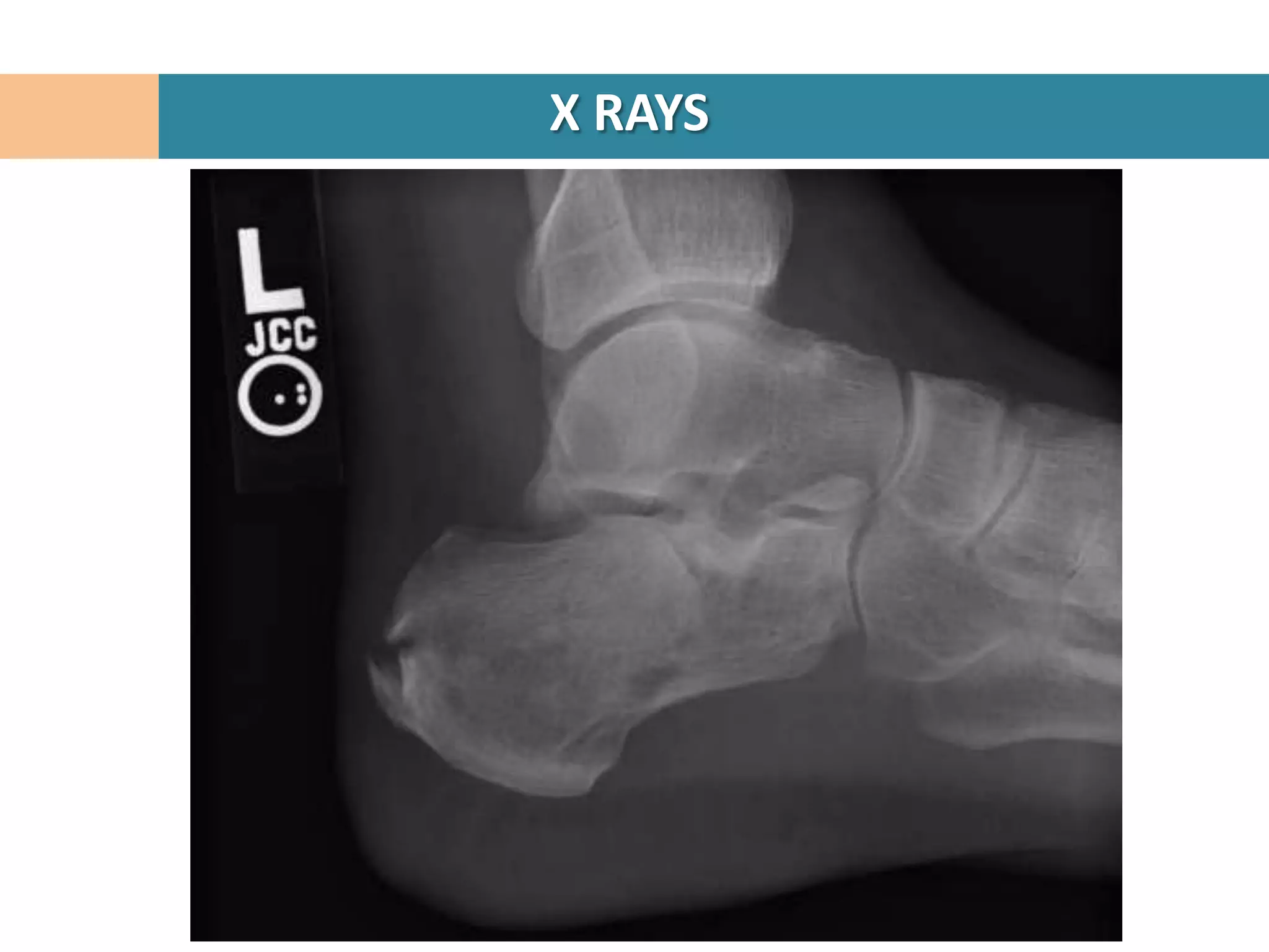 X RAYS
 