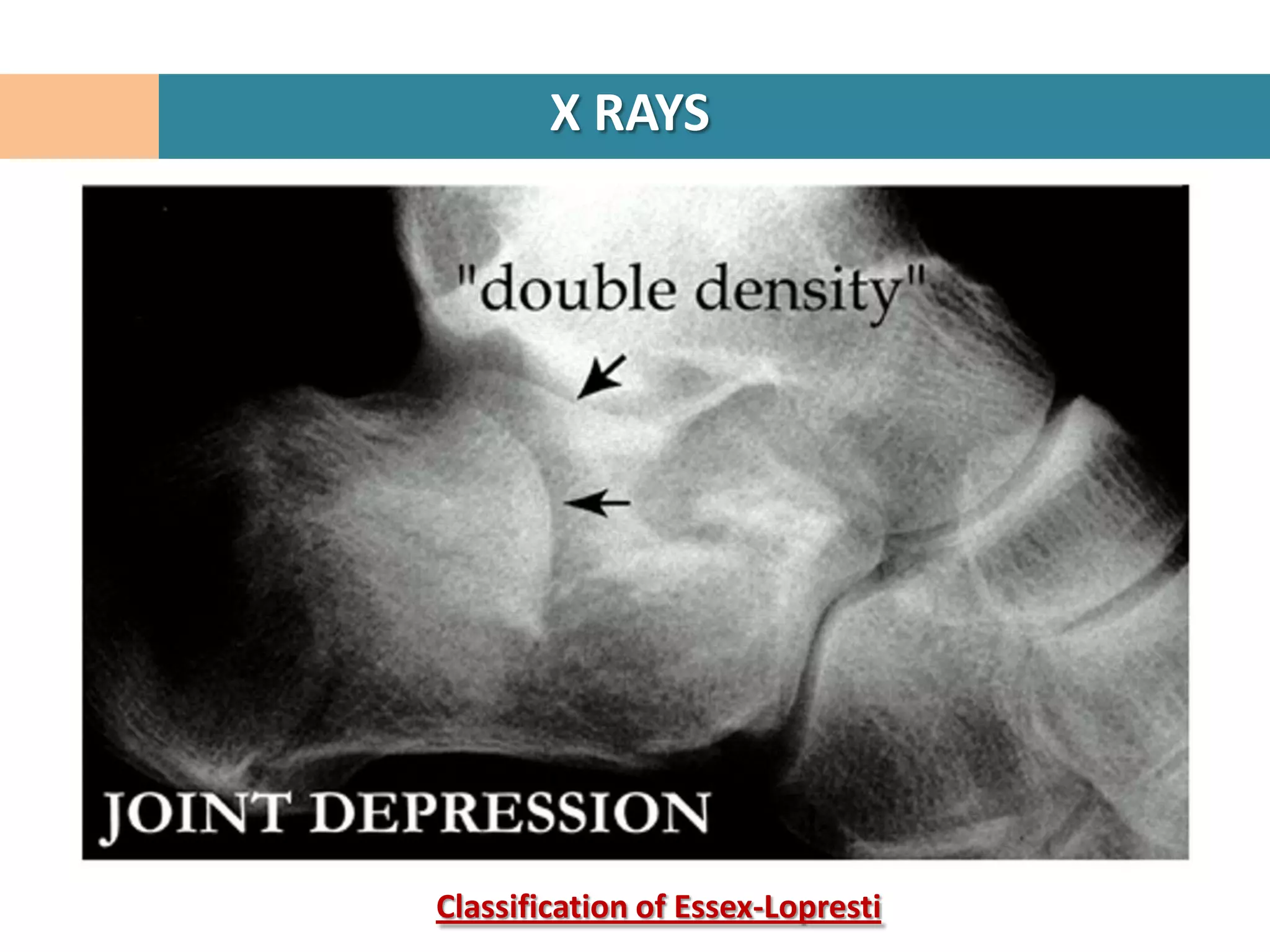 X RAYS




Classification of Essex-Lopresti
 