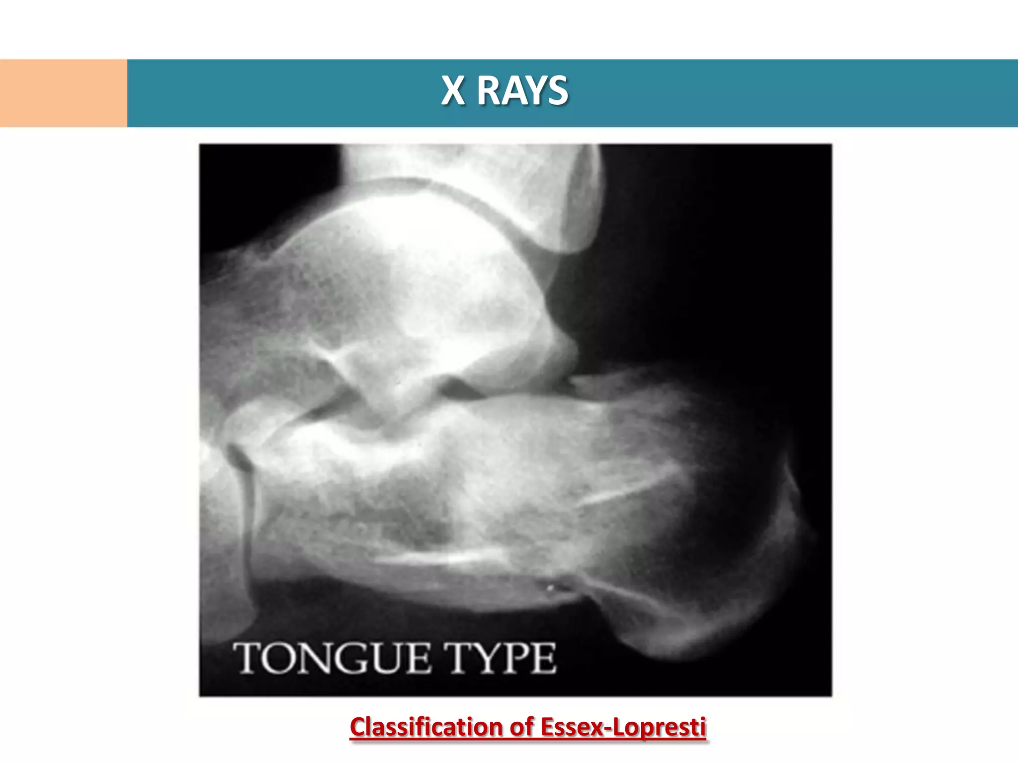 X RAYS




Classification of Essex-Lopresti
 