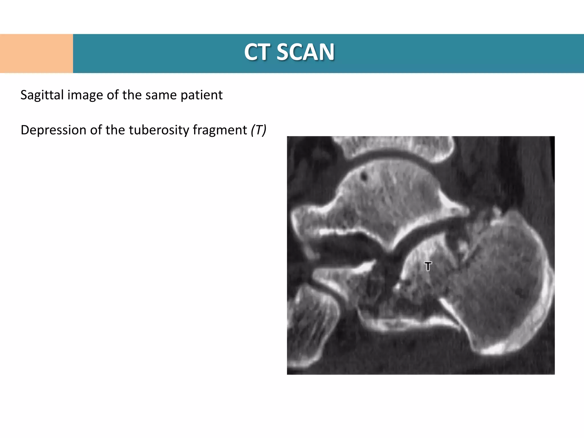 CT SCAN
Sagittal image of the same patient

Depression of the tuberosity fragment (T)
 