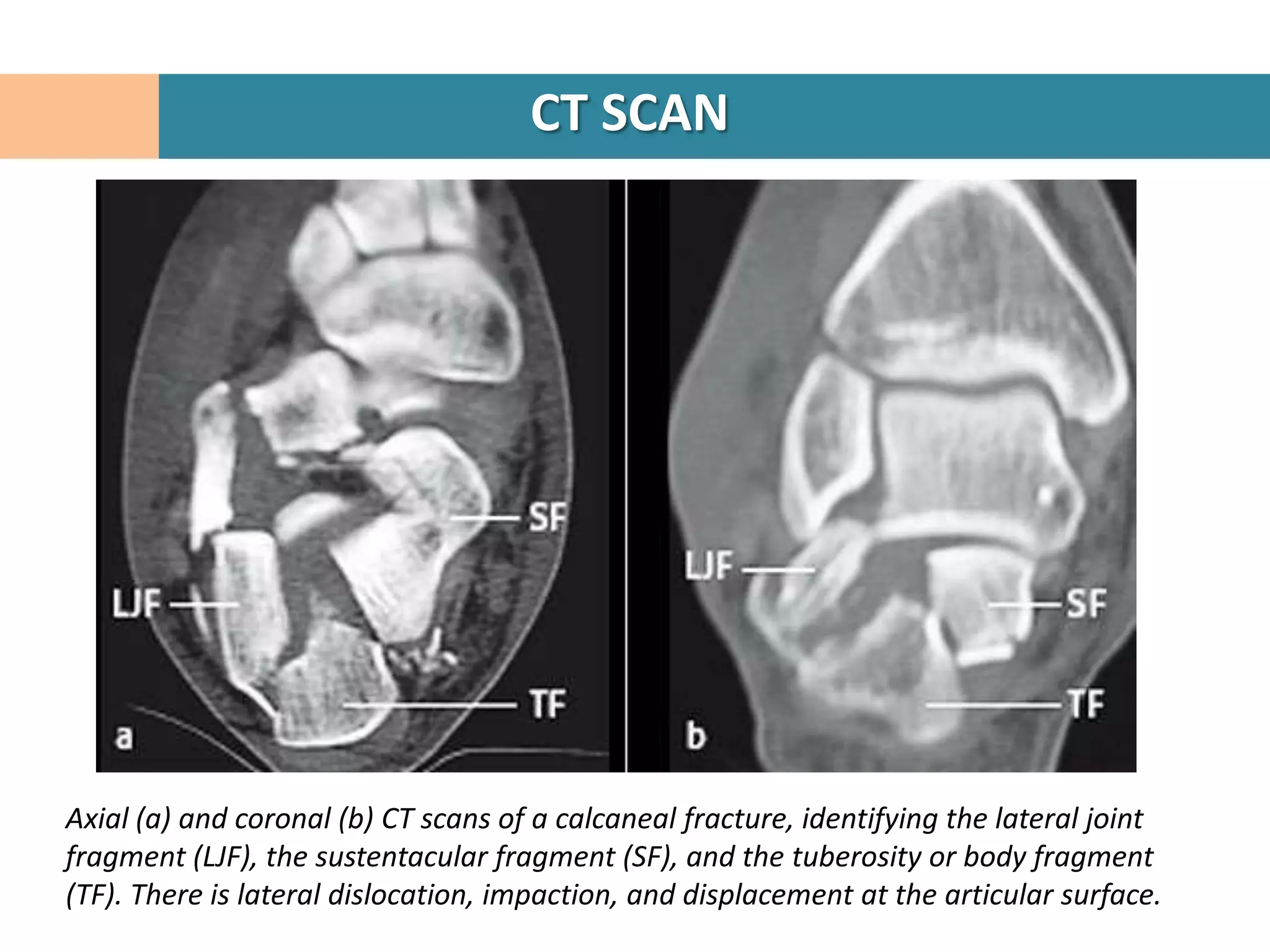 CT SCAN




Axial (a) and coronal (b) CT scans of a calcaneal fracture, identifying the lateral joint
fragment (LJF), the sustentacular fragment (SF), and the tuberosity or body fragment
(TF). There is lateral dislocation, impaction, and displacement at the articular surface.
 
