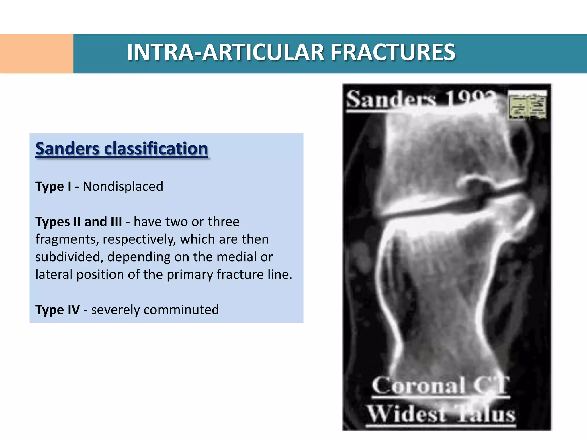 INTRA-ARTICULAR FRACTURES


Sanders classification
Type I - Nondisplaced

Types II and III - have two or three
fragments, respectively, which are then
subdivided, depending on the medial or
lateral position of the primary fracture line.

Type IV - severely comminuted
 